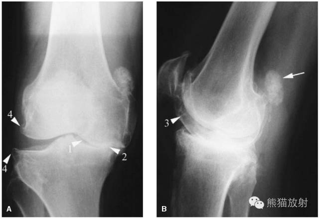 膝关节、胫腓骨——临床影像示例