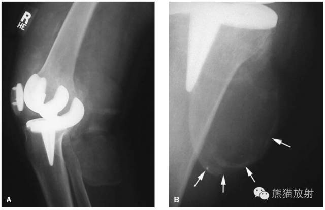 膝关节、胫腓骨——临床影像示例
