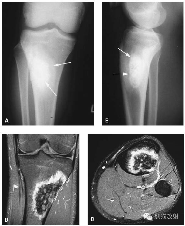 膝关节、胫腓骨——临床影像示例