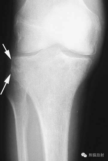 膝关节、胫腓骨——临床影像示例