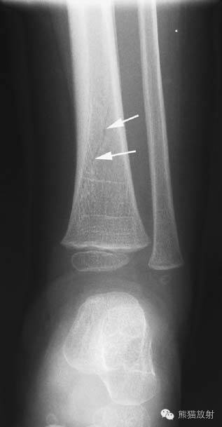 膝关节、胫腓骨——临床影像示例