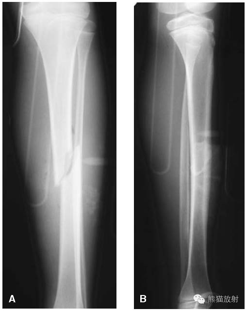 膝关节、胫腓骨——临床影像示例