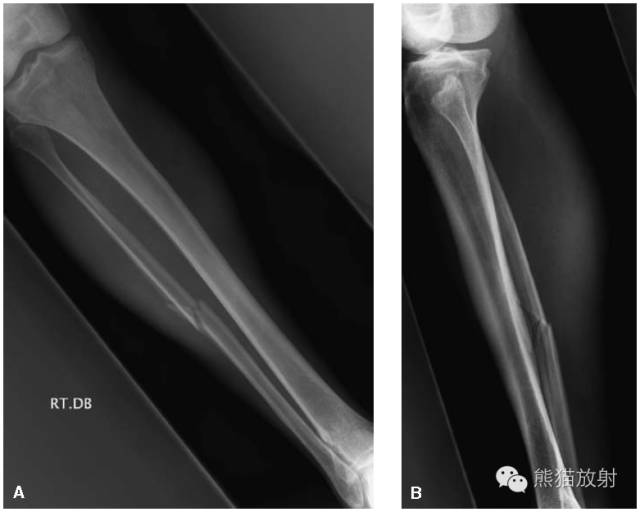 膝关节、胫腓骨——临床影像示例