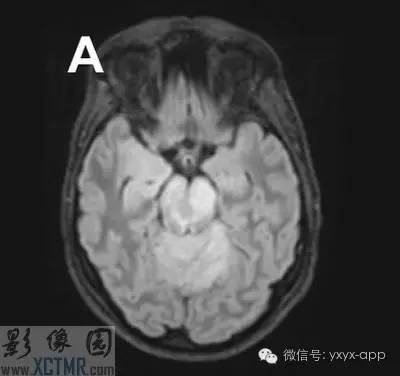 【病例】大脑胶质瘤病1例MR影像表现 【病例】大脑胶质瘤病1例MR影像表现