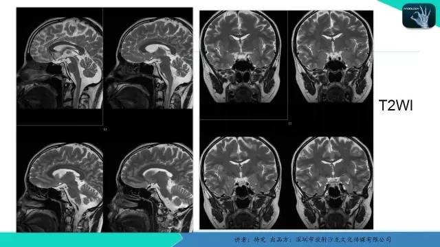 【病例】垂体柄阻断综合征1例MR影像表现