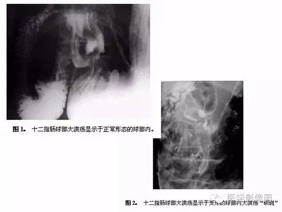 【PPT】十二指肠溃疡的影像学诊断