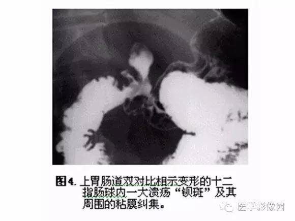 【PPT】十二指肠溃疡的影像学诊断