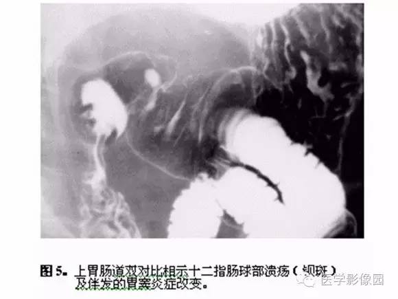 【PPT】十二指肠溃疡的影像学诊断