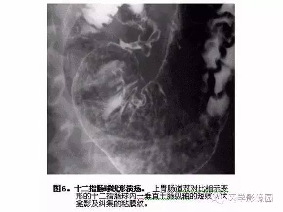 【PPT】十二指肠溃疡的影像学诊断