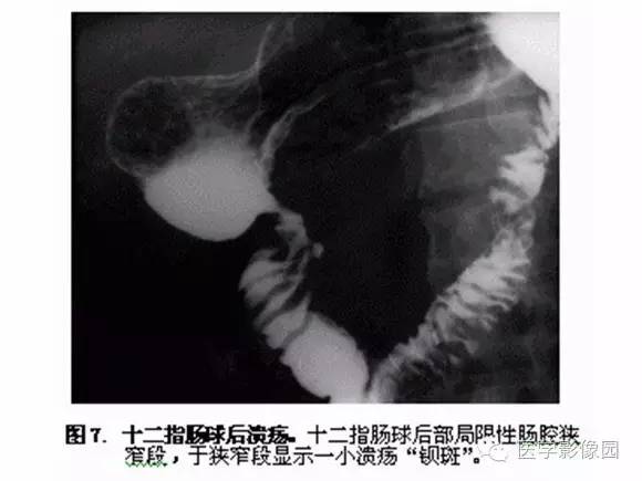 【PPT】十二指肠溃疡的影像学诊断