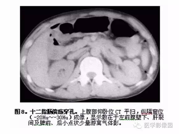 【PPT】十二指肠溃疡的影像学诊断