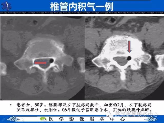【PPT】椎管内积气，一个易被忽视的影像