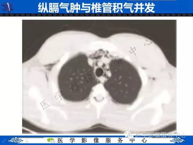【PPT】椎管内积气，一个易被忽视的影像