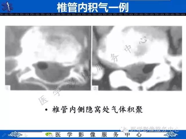 【PPT】椎管内积气，一个易被忽视的影像