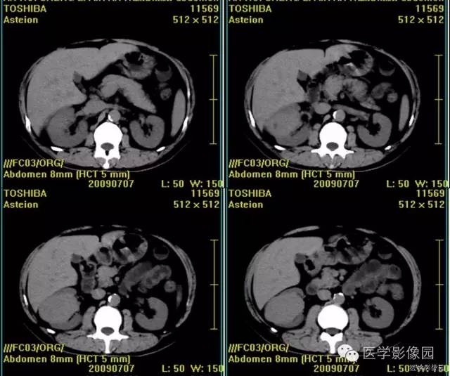 【病例】肾乏脂肪血管平滑肌脂肪瘤1例CT影像表现