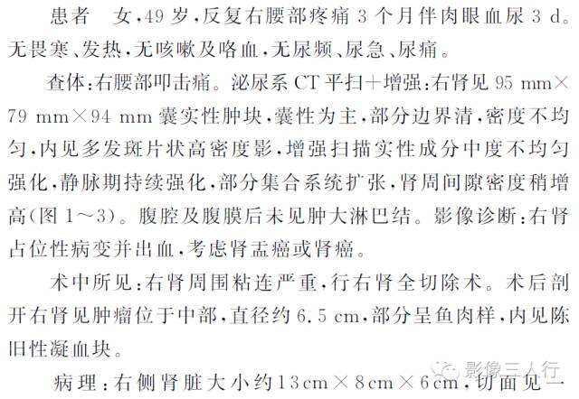 【病例】右肾滑膜肉瘤1例CT影像表现