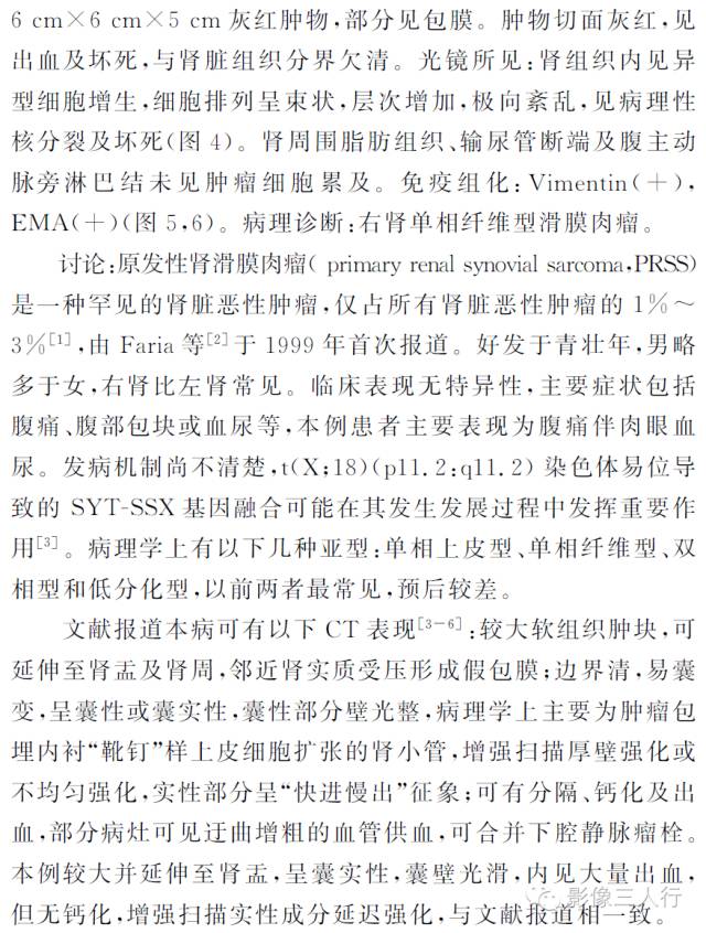 【病例】右肾滑膜肉瘤1例CT影像表现