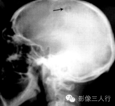 "纽扣样死骨"，这个征象提示啥？