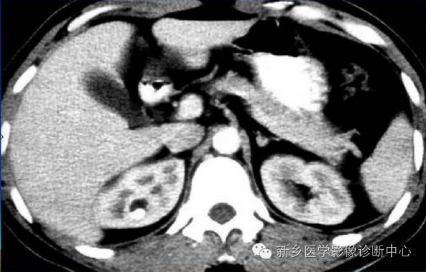 肾盂肾盏憩室 肾盂肾盏憩室