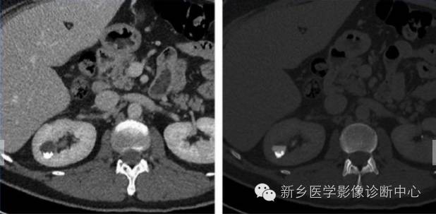 肾盂肾盏憩室 肾盂肾盏憩室