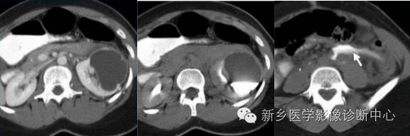 肾盂肾盏憩室 肾盂肾盏憩室