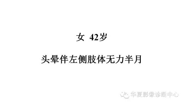 【病例】幕上脑实质室管膜瘤1例CT及MR