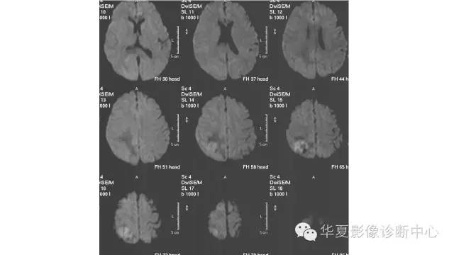 【病例】幕上脑实质室管膜瘤1例CT及MR