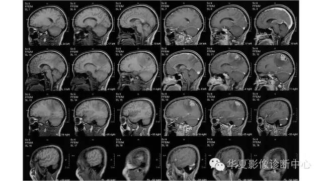 【病例】幕上脑实质室管膜瘤1例CT及MR
