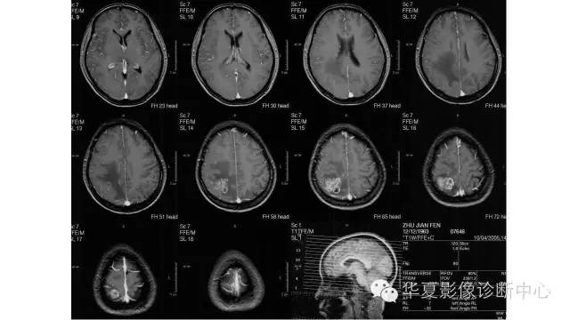 【病例】幕上脑实质室管膜瘤1例CT及MR