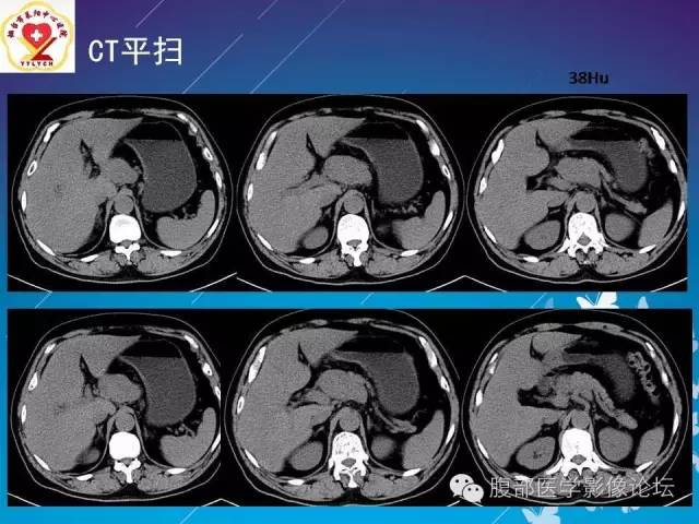 【病例】胃窦癌腹膜后淋巴结转移1例CT及MR