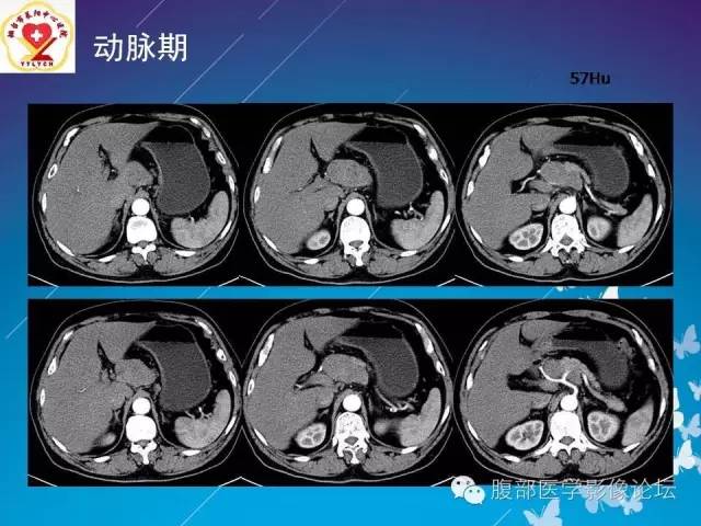 【病例】胃窦癌腹膜后淋巴结转移1例CT及MR