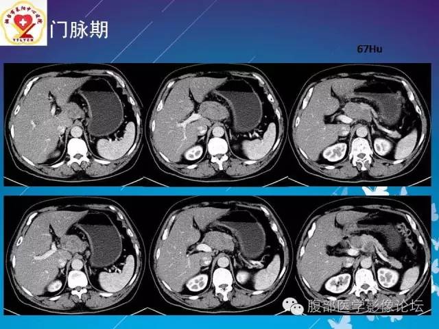 【病例】胃窦癌腹膜后淋巴结转移1例CT及MR