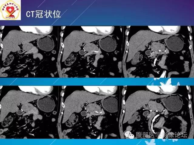 【病例】胃窦癌腹膜后淋巴结转移1例CT及MR