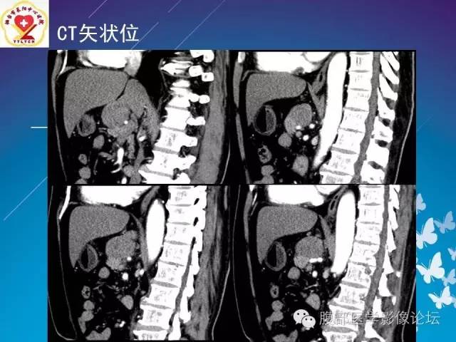 【病例】胃窦癌腹膜后淋巴结转移1例CT及MR