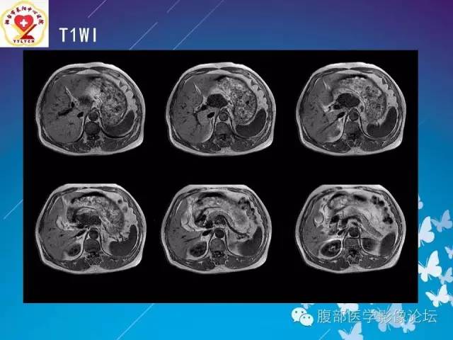 【病例】胃窦癌腹膜后淋巴结转移1例CT及MR
