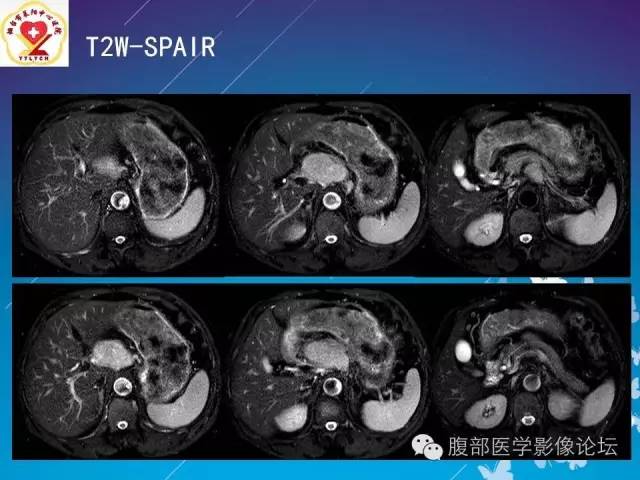 【病例】胃窦癌腹膜后淋巴结转移1例CT及MR