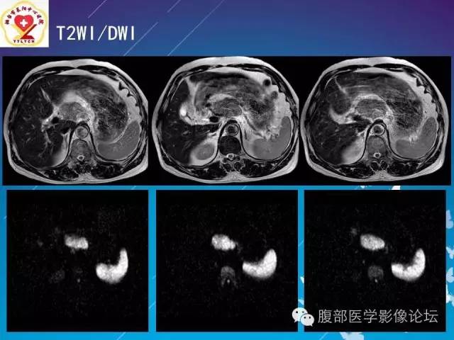 【病例】胃窦癌腹膜后淋巴结转移1例CT及MR