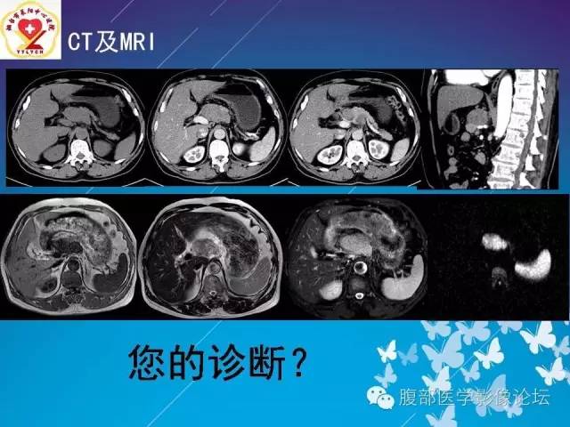 【病例】胃窦癌腹膜后淋巴结转移1例CT及MR