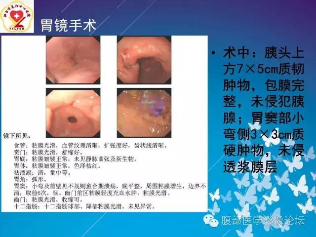 【病例】胃窦癌腹膜后淋巴结转移1例CT及MR