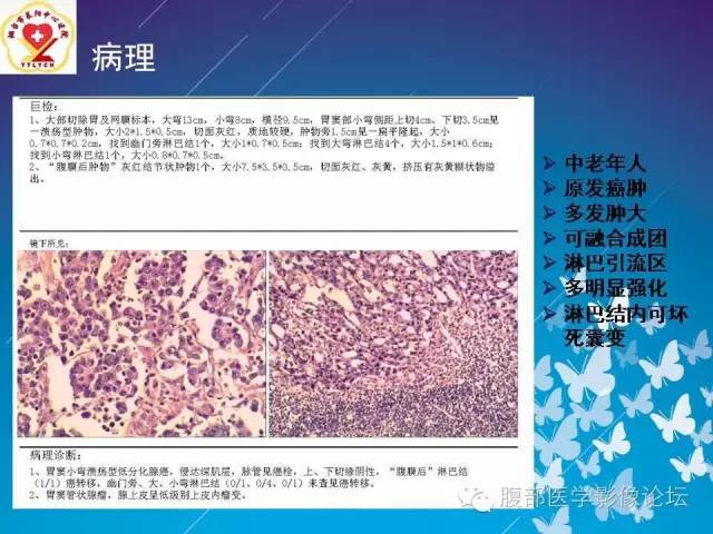 【病例】胃窦癌腹膜后淋巴结转移1例CT及MR