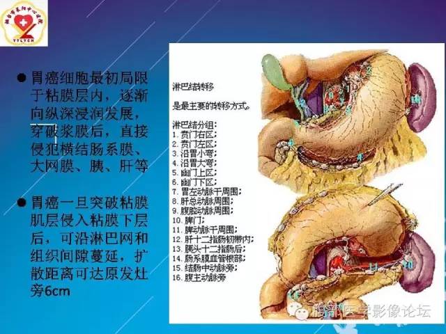 【病例】胃窦癌腹膜后淋巴结转移1例CT及MR