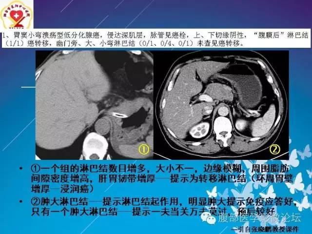 【病例】胃窦癌腹膜后淋巴结转移1例CT及MR