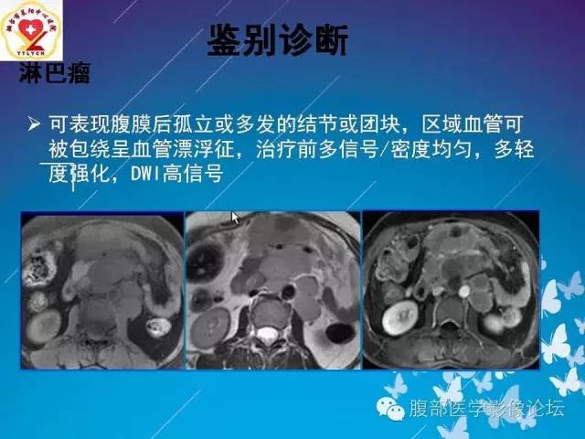 【病例】胃窦癌腹膜后淋巴结转移1例CT及MR