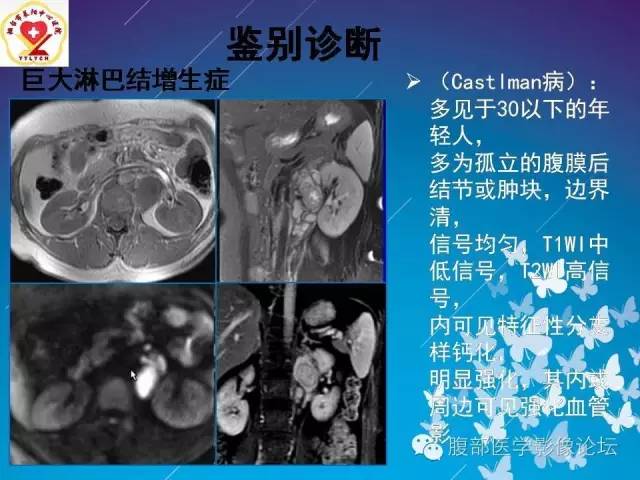 【病例】胃窦癌腹膜后淋巴结转移1例CT及MR