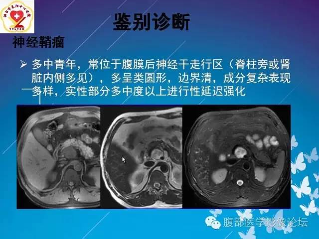 【病例】胃窦癌腹膜后淋巴结转移1例CT及MR