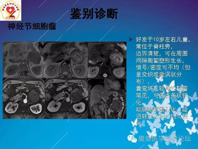 【病例】胃窦癌腹膜后淋巴结转移1例CT及MR