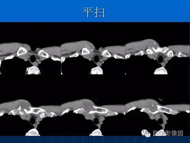 【病例】胸骨软骨肉瘤1例CT影像表现 【病例】胸骨软骨肉瘤1例CT影像表现