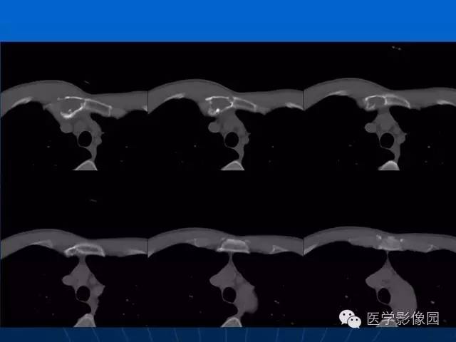 【病例】胸骨软骨肉瘤1例CT影像表现 【病例】胸骨软骨肉瘤1例CT影像表现
