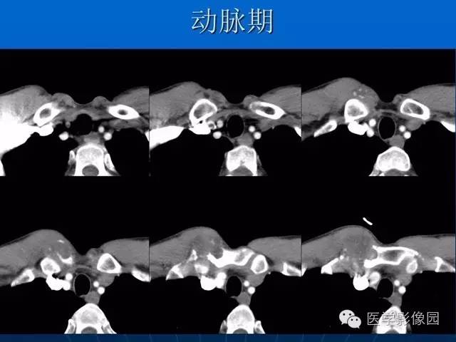 【病例】胸骨软骨肉瘤1例CT影像表现 【病例】胸骨软骨肉瘤1例CT影像表现