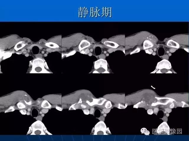 【病例】胸骨软骨肉瘤1例CT影像表现 【病例】胸骨软骨肉瘤1例CT影像表现